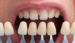 Dental Veneers