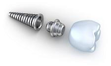 dental implants