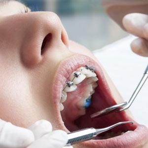 braces-makeover-300.jpg