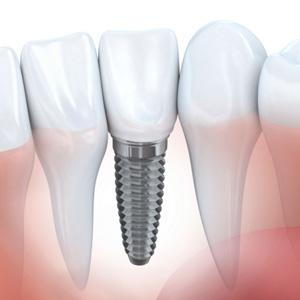 dental-implant2-300.jpg