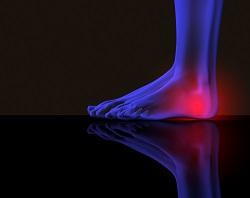 Plantar Fasciitis Foot Pain