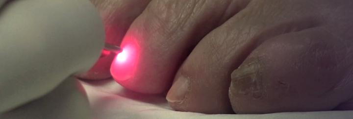 Laser treatment of toenail fungus