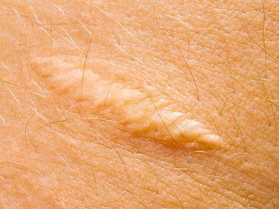 skin scar tissue