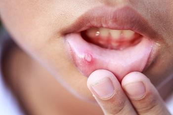 Canker sores appear within the mouth