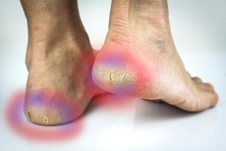 How to Treat Heel Fissures by Dr. Jack Andrew Harvey of Manteca, CA