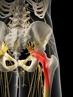 sciatica