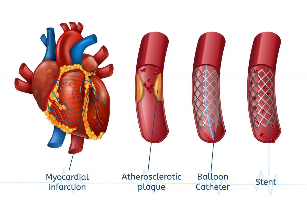 Angioplasty