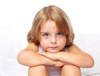 Your Child and Chicken Pox