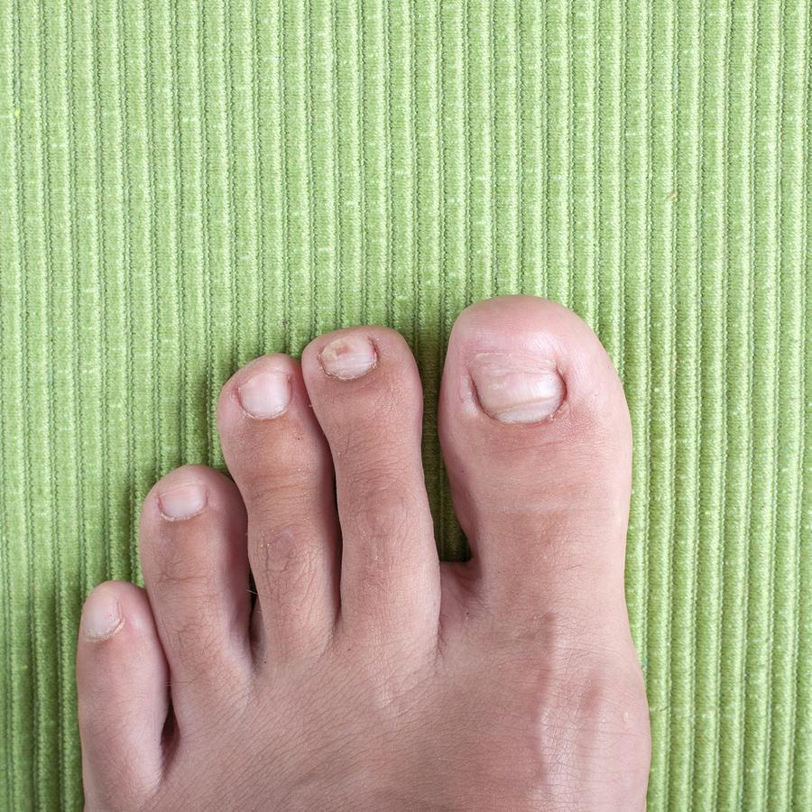 Ingrown Toenail Treatment – My FootDr