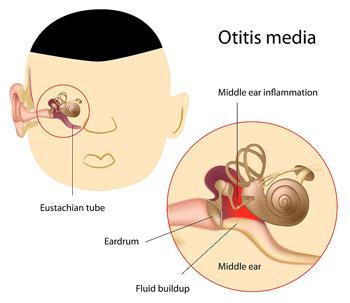 Ear Infection