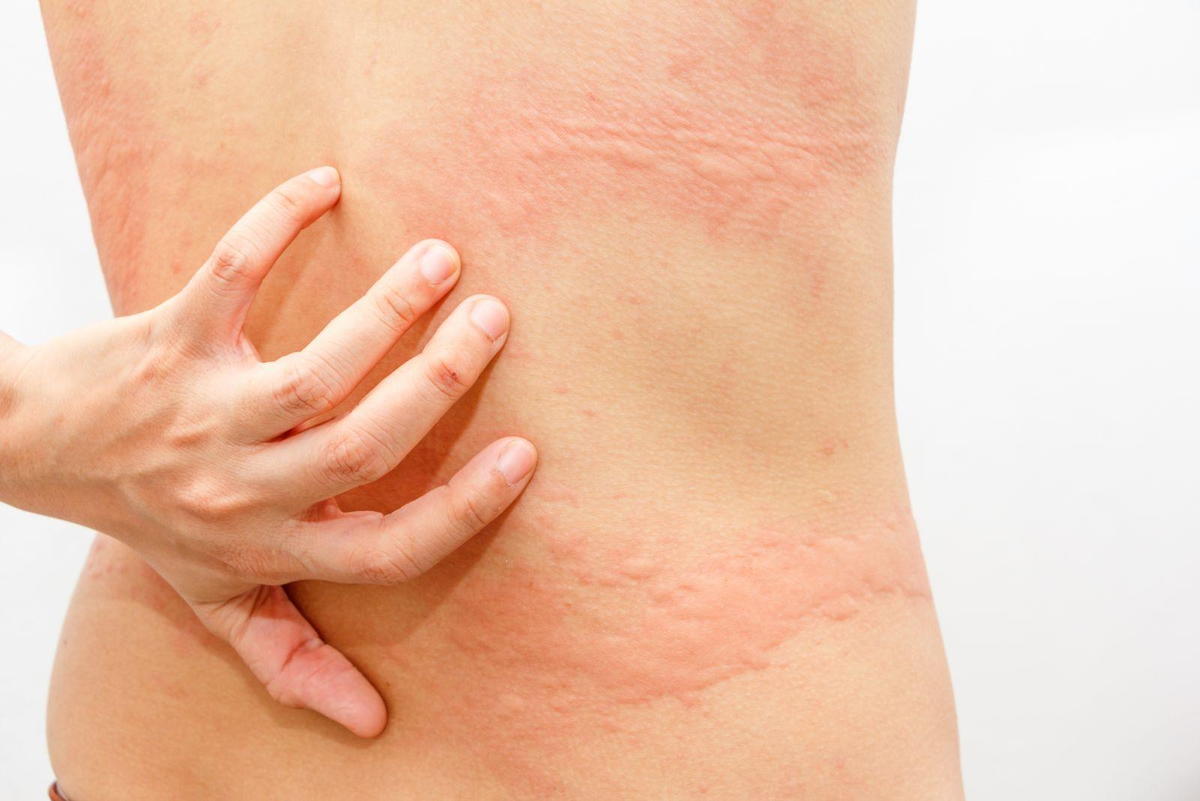 Hives Urticaria Meaning In Tamil