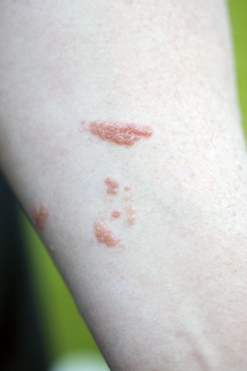 Poison Ivy Rash, Poison Oak, Poison Sumac: Symptoms, Causes