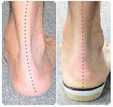 Image result for flat feet