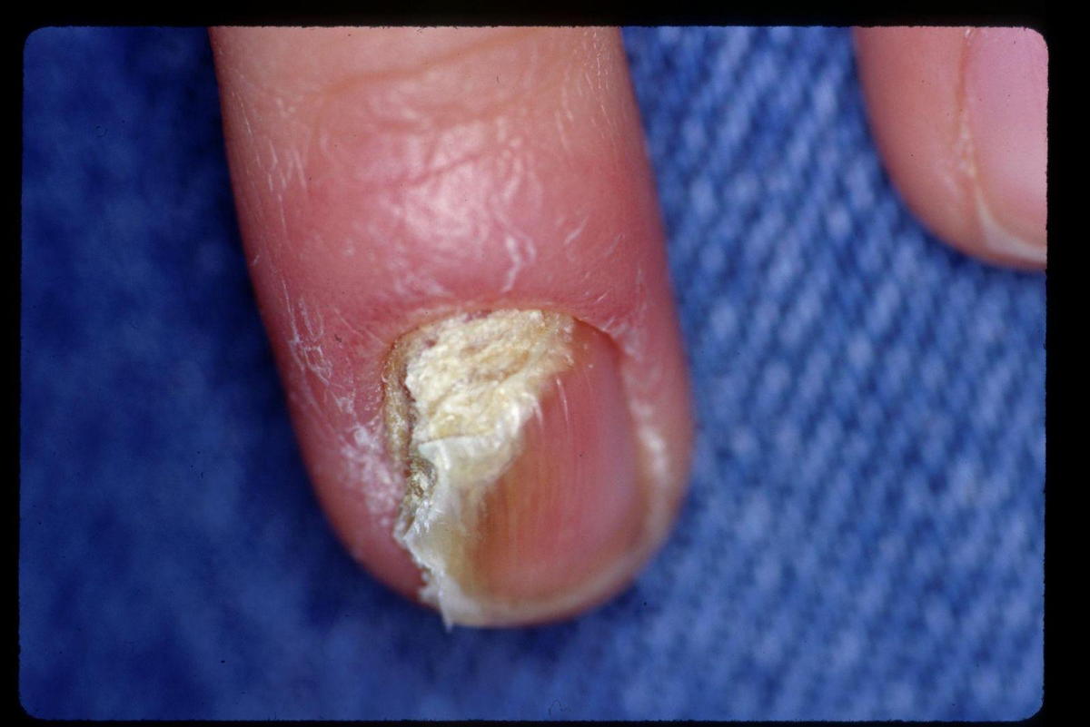 Patient with Nail Psoriasis