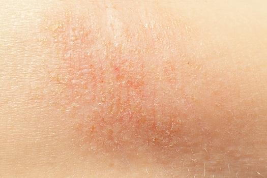 Patch of dry skin