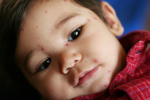 Child with Chicken Pox