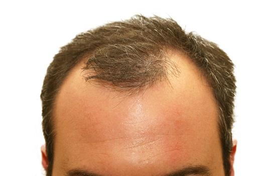 There's Help for Hair Loss