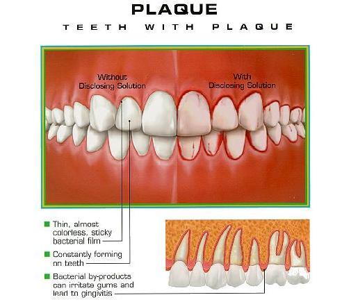 Plaque on teeth on sale how to remove