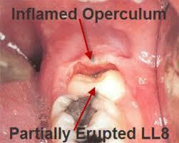 pericoronitis infection