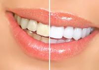 Side by side teeth whitening results