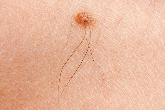 skin cancer mole