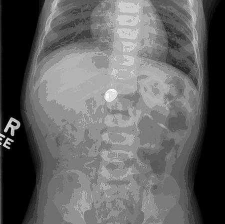 Children can suffer serious injuries or die if they swallow button batteries. Photo courtesy of Robert E. Kramer, M.D.