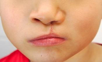 Cleft palates can be reconstructed