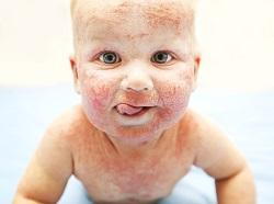 infant rash