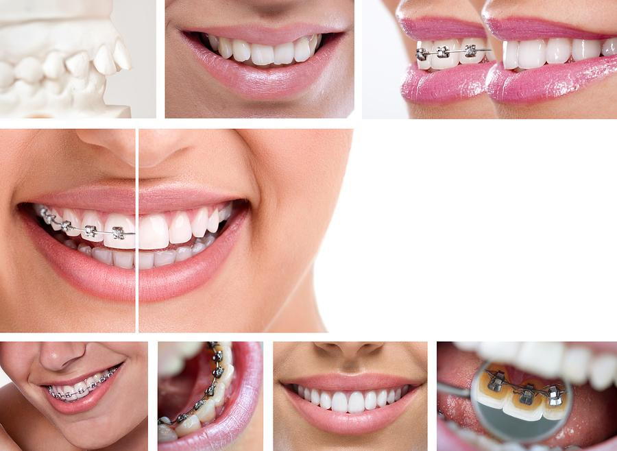 Determining The When & Why You Need Braces - Types of Braces