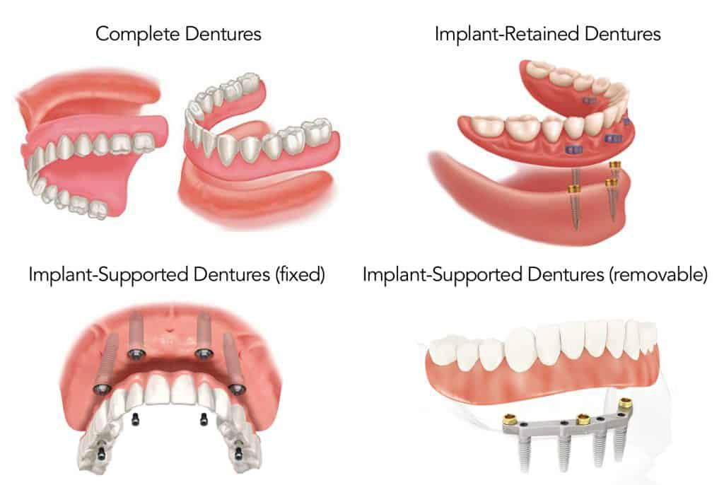 implant-denture-vs-all-on-4.jpg