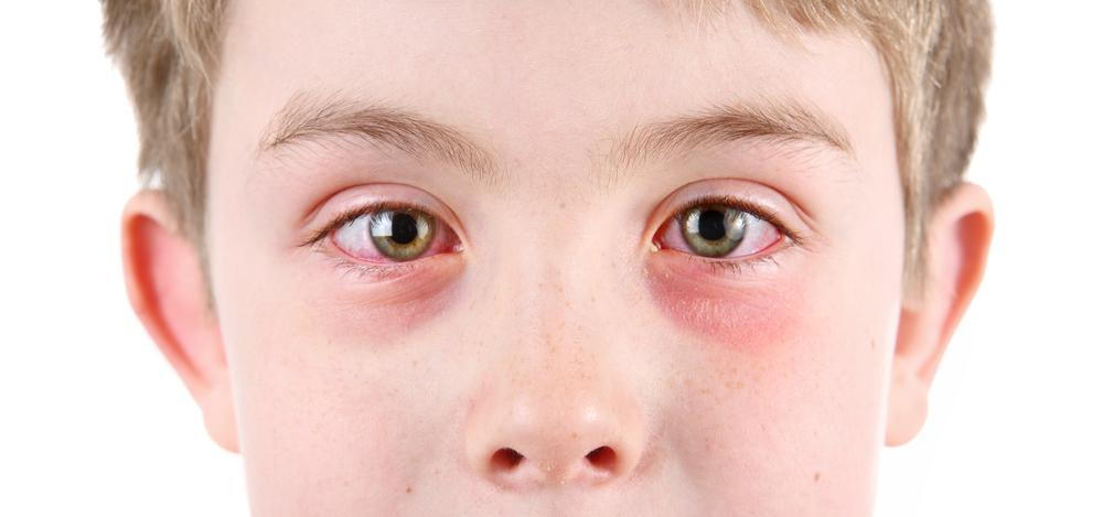 boy with pink eye before seeing a Lancaster Optometrist