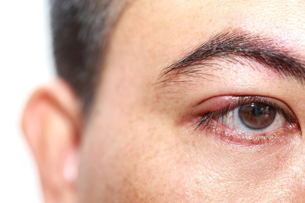 difference between viral and bacterial pink eye