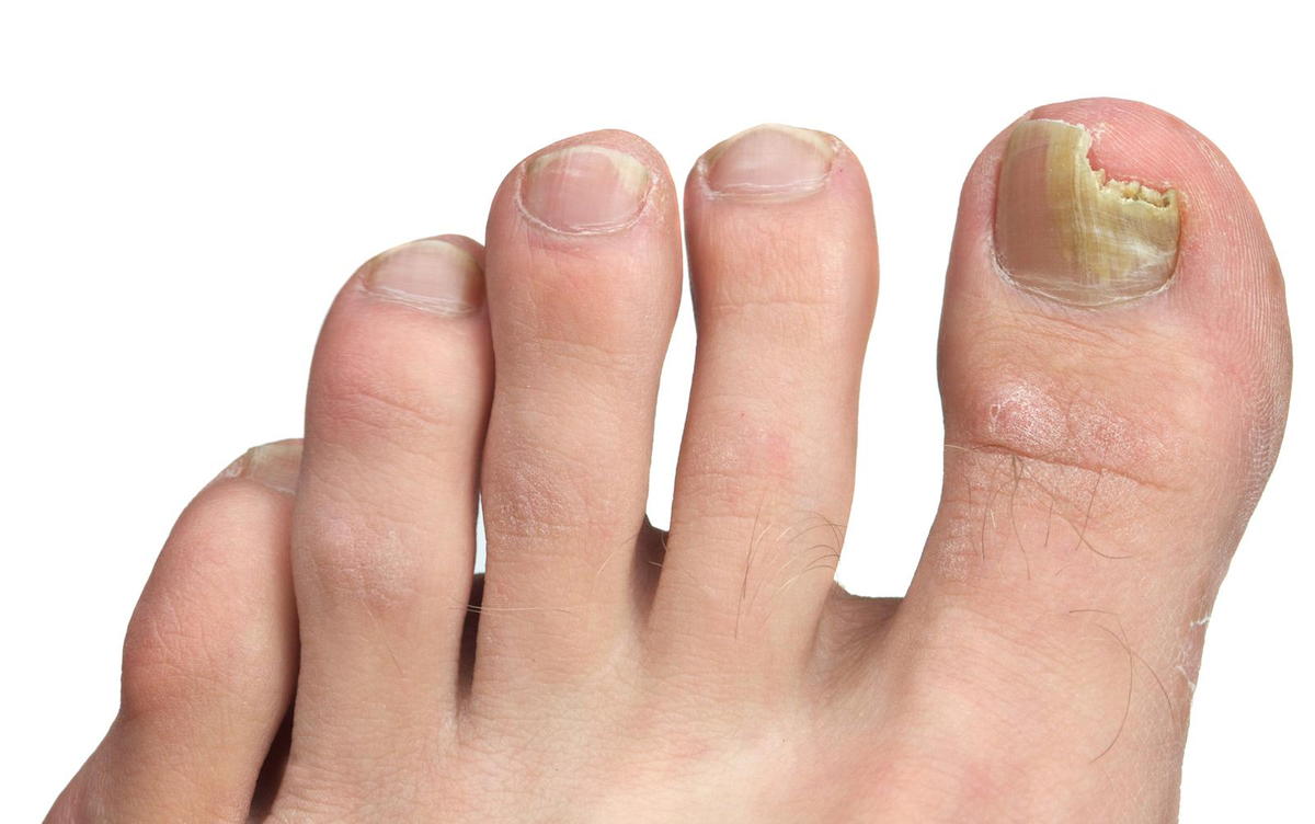 Help Your Toenails Grow Back Healthily After a Fungal Nail Infection –  Scholl UK